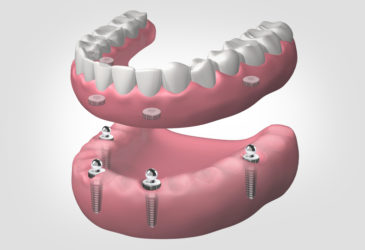 implantes dentales en Zaidía Valencia